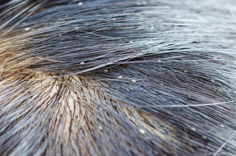 Eggs From Lice in a Child's Hair
